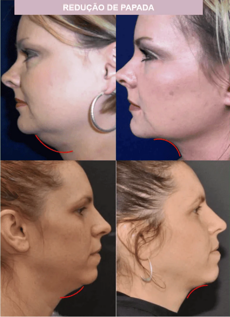 Modelador de Rosto - ProFace